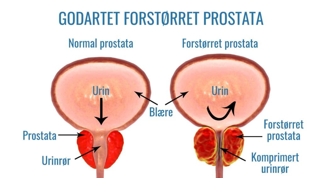 forstørret prostata